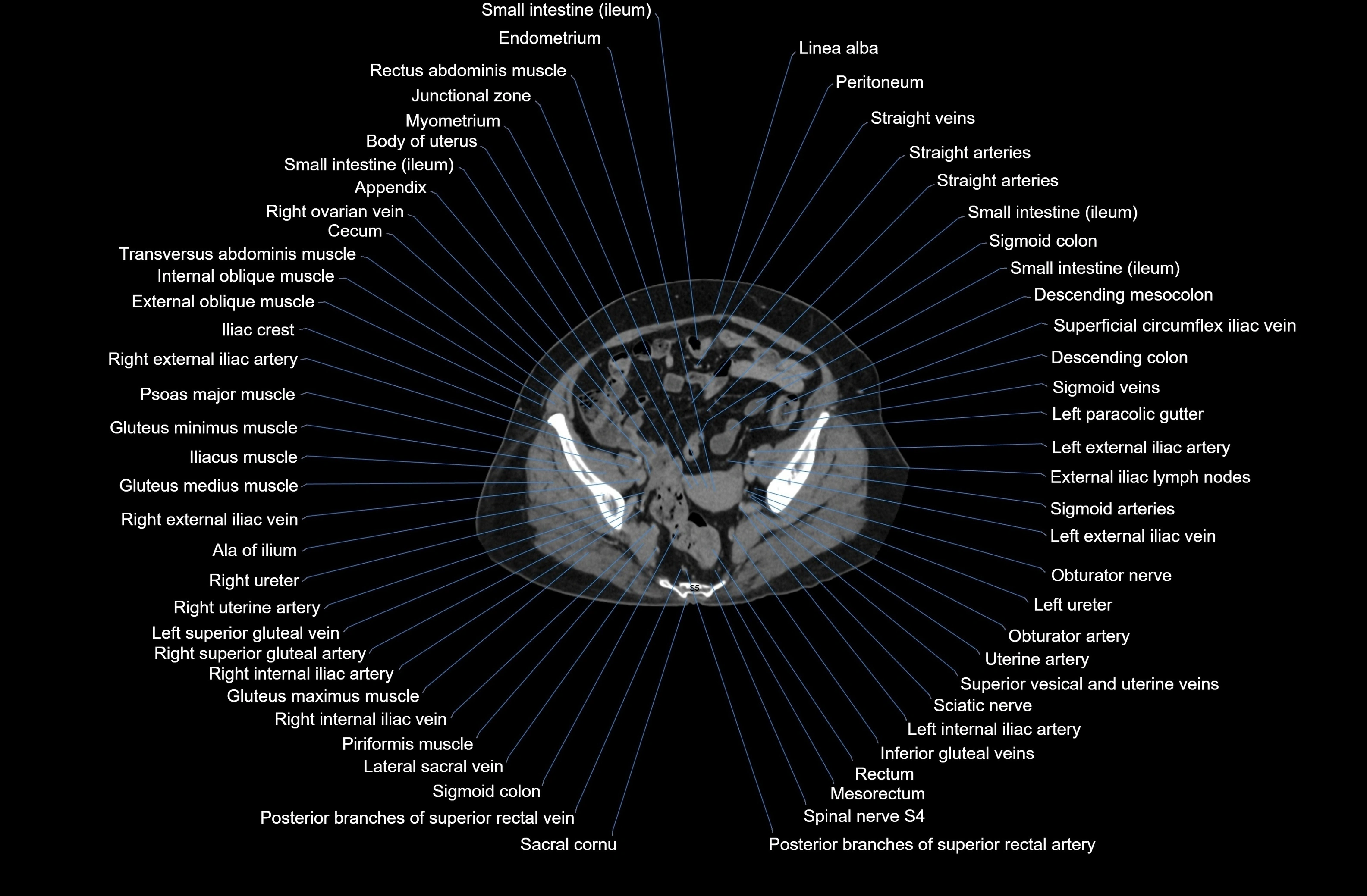 CT Abdomen axial cross sectional anatomy labelled radiology image-00078.webp